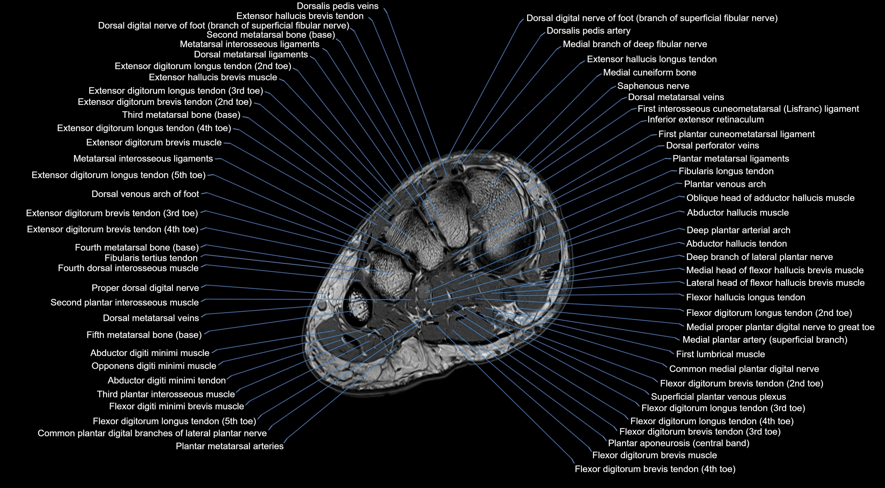 MRI mid foot coronal ligaments cross sectional anatomy 3T  radiology  image-img-00001-00015.webp